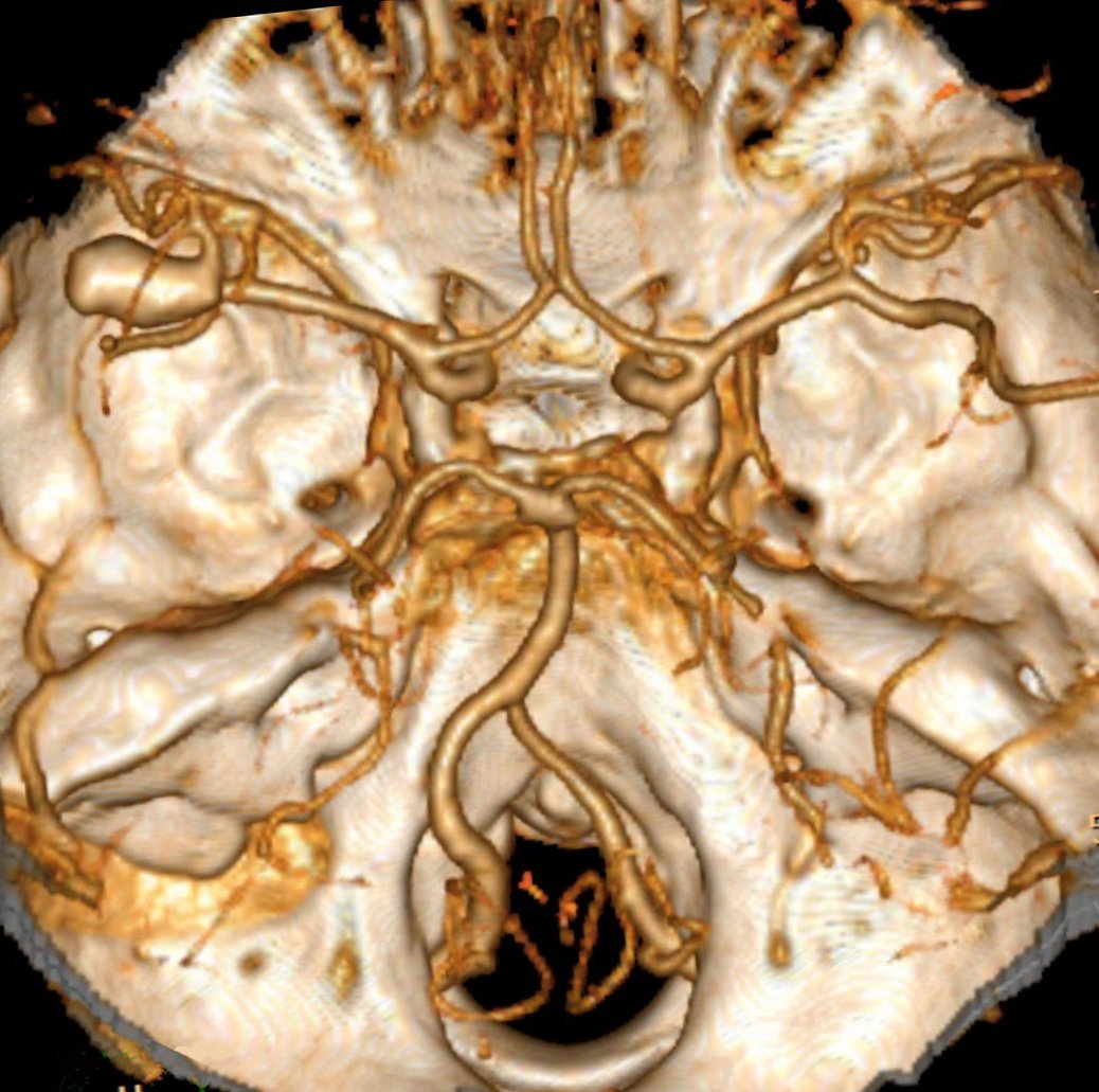 Aneurysm Clipping