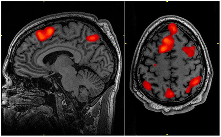 Awake Craniotomy