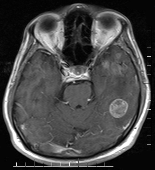 Brain Metastases