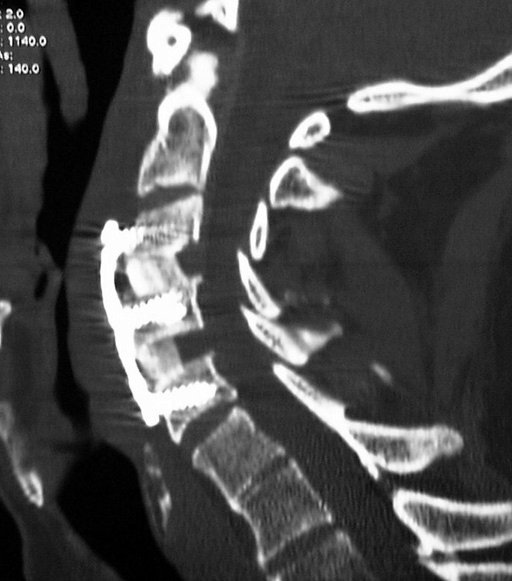 Cervical Spondylosis