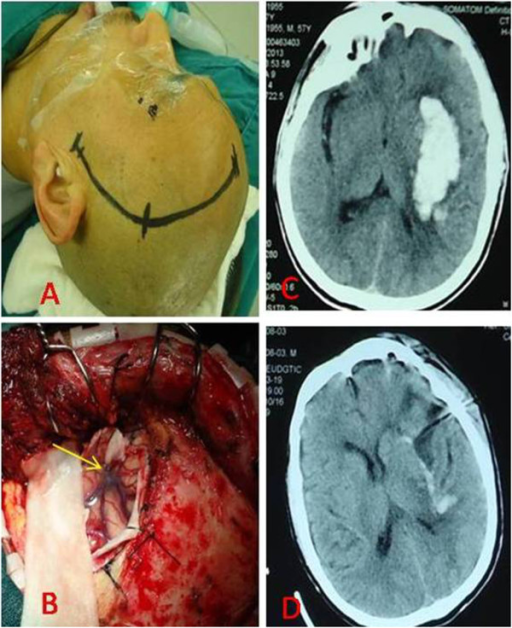 Craniotomy