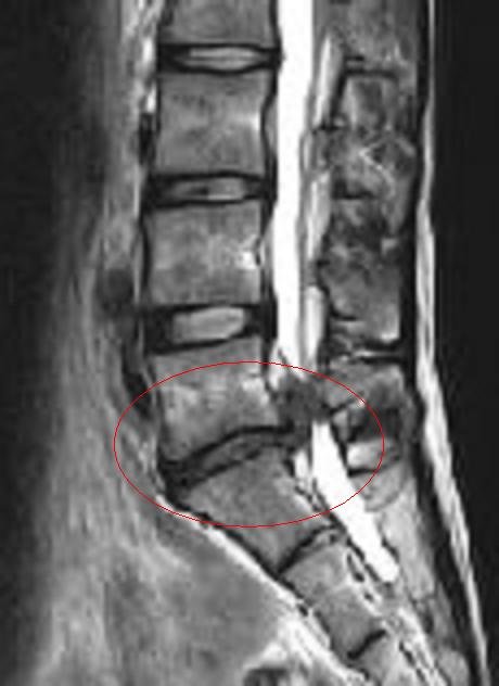Disc Prolapse (Herniated Disc)