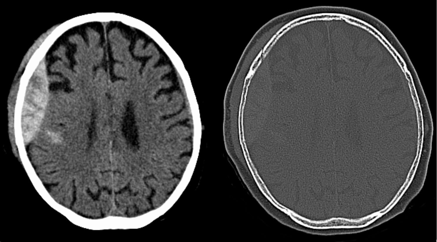 Emergency Craniotomy
