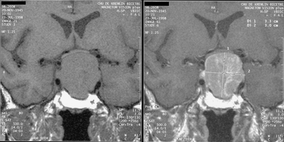 Endonasal Pituitary Surgery