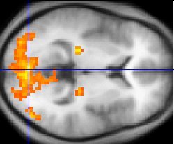 Epilepsy Surgery | مرگی کی سرجری Epilepsy Surgery