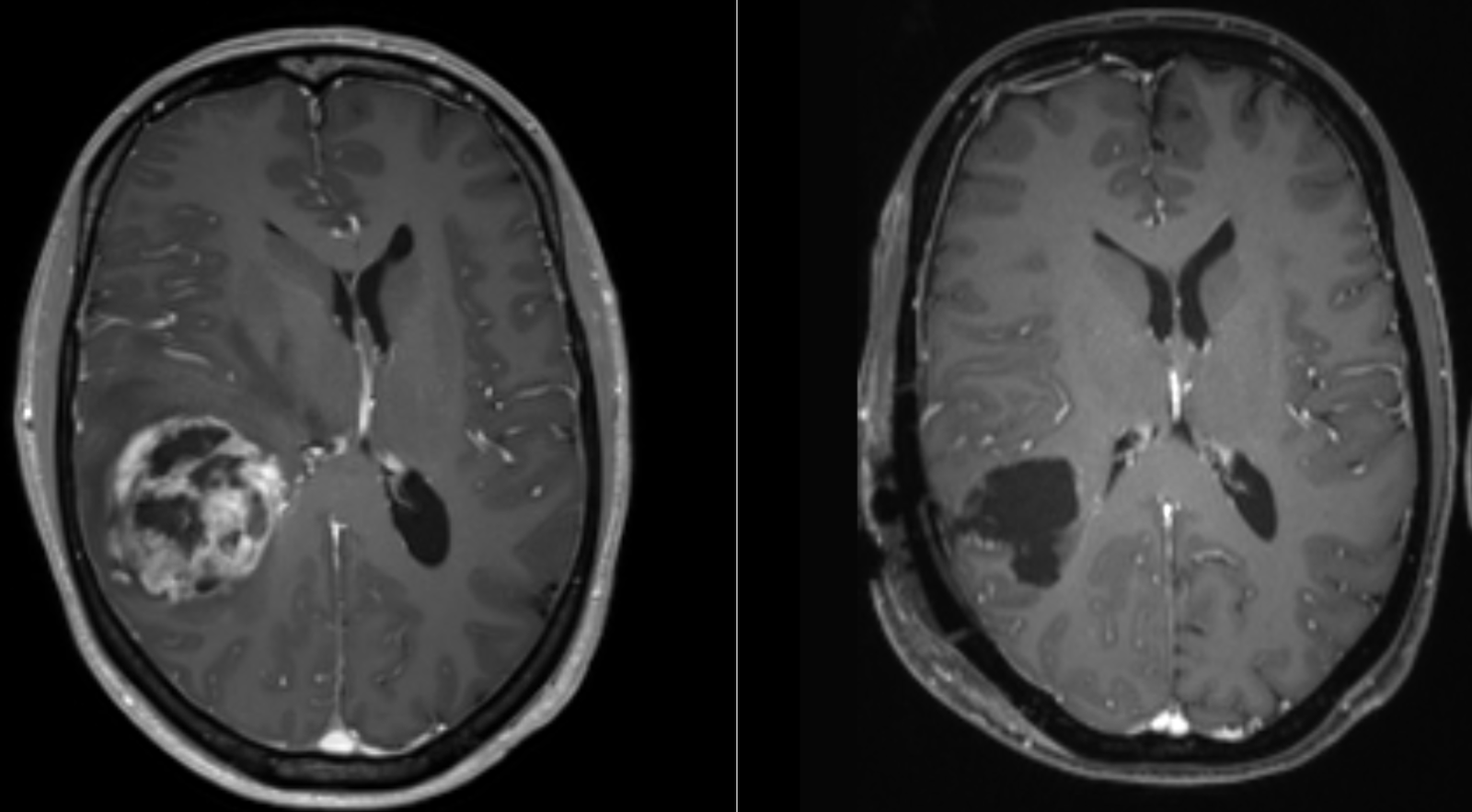 Glioma & Glioblastoma
