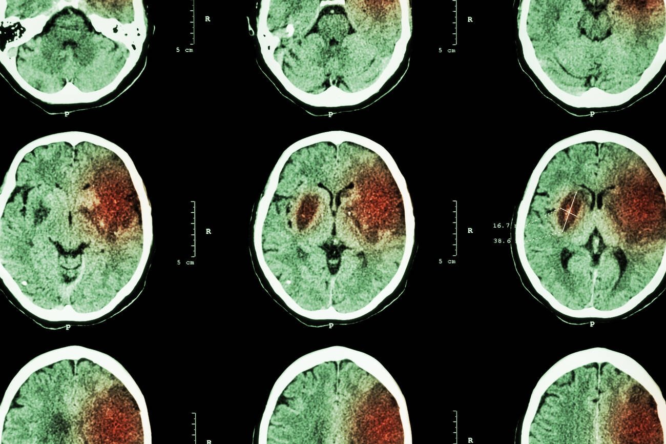 Haemorrhagic Stroke Care