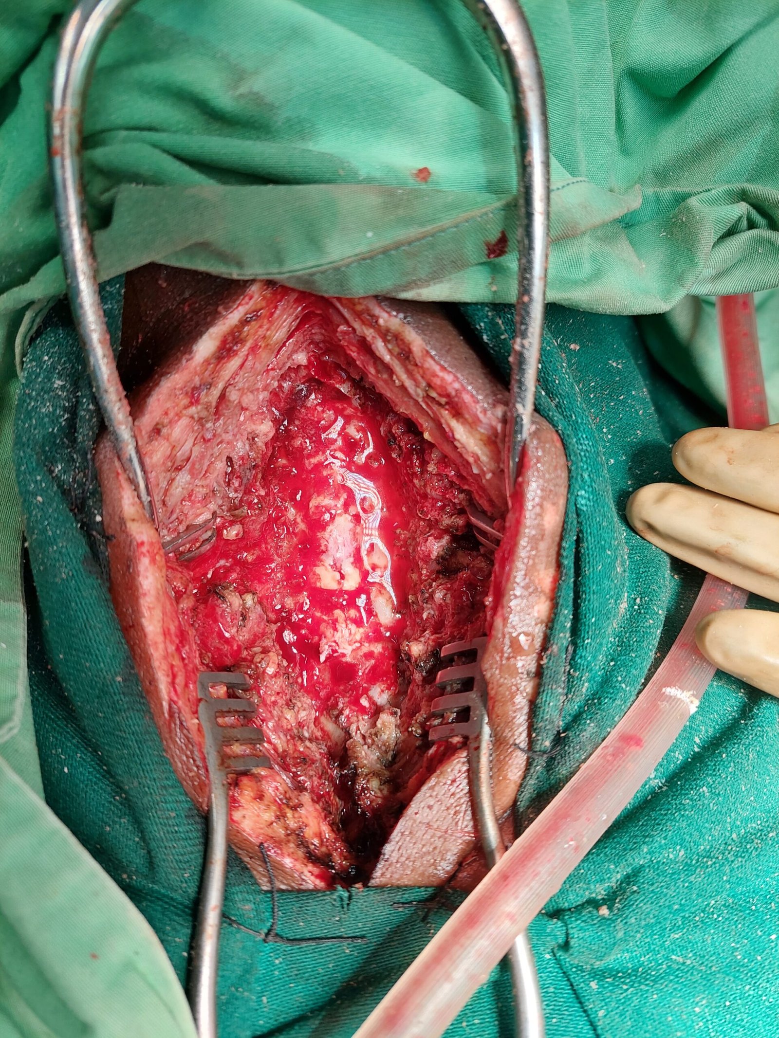 Laminectomy
