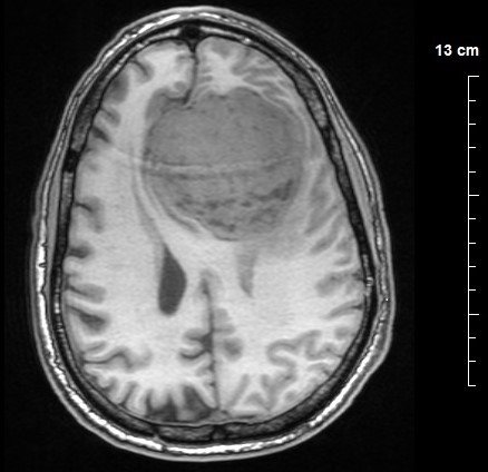 Meningioma