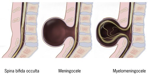 Myelomeningocele | مائیلو میننگو سیل Myelomeningocele