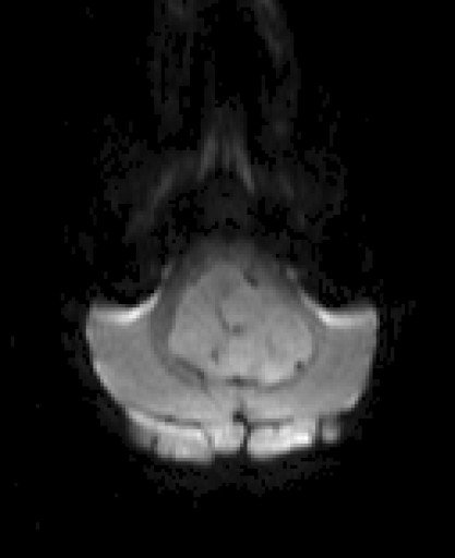 Paediatric Brain Tumors