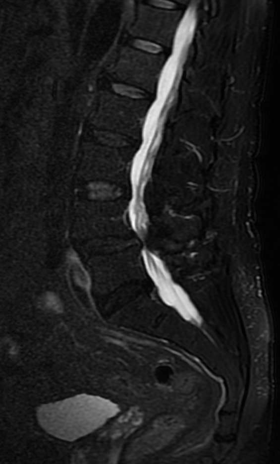 Spinal Decompression