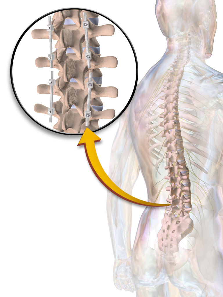 Spinal Instrumentation & Fixation