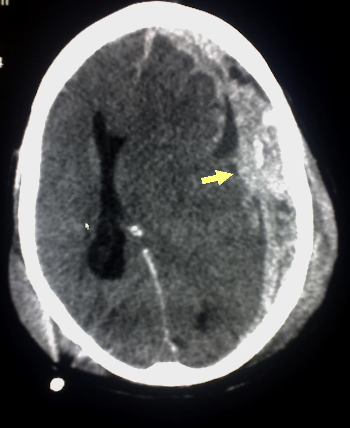 Subdural & Extradural Hematoma | سب ڈیورل اور ایکسٹرا ڈیورل ہیماٹوما Subdural & Extradural Hematoma
