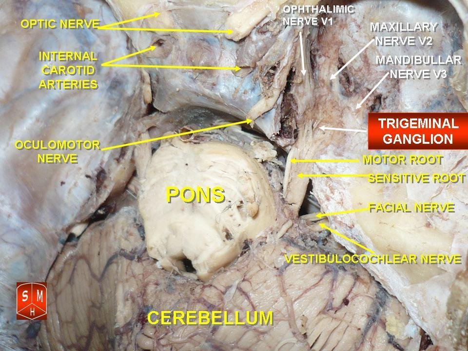Trigeminal Neuralgia