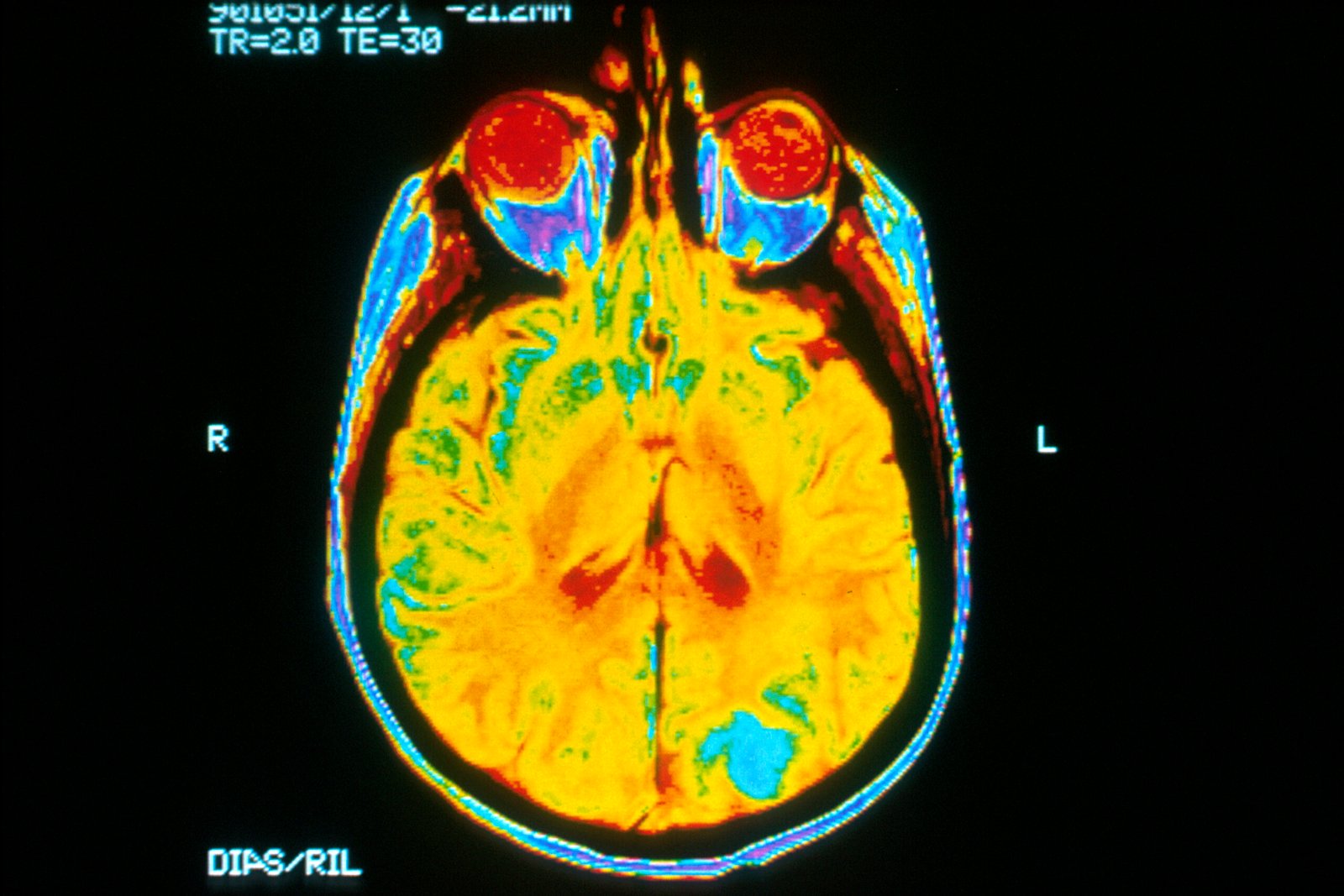 Brain Tumor Resection